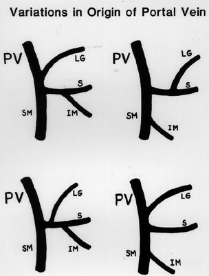 Image of variation in origin of portal vein