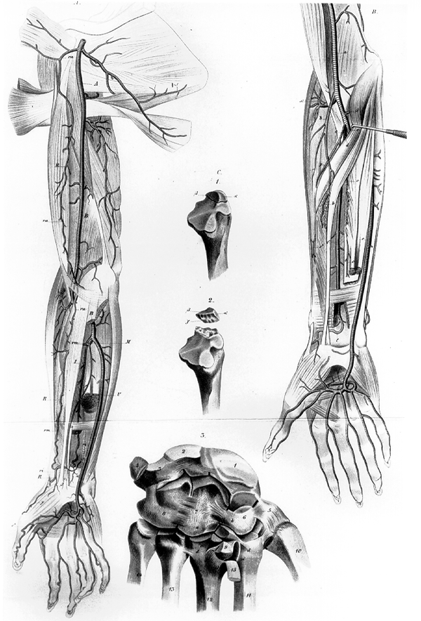 Image of the radial artery with three roots and rudimentary radial artery, accessory branches of the median and anterior interosseous arteries
