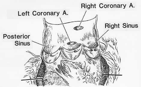 Image of anomalous origin of right coronary artery