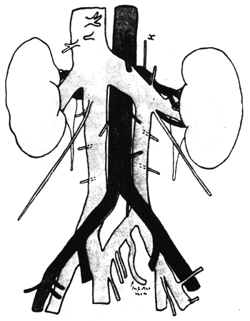 Image of duplication of postrenal segment of inferior vena cava