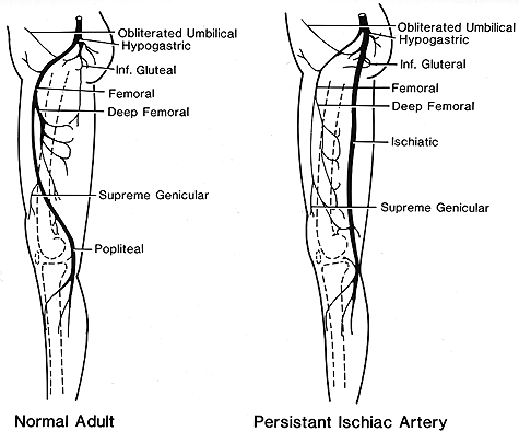 Image of persistent ischiatic artery