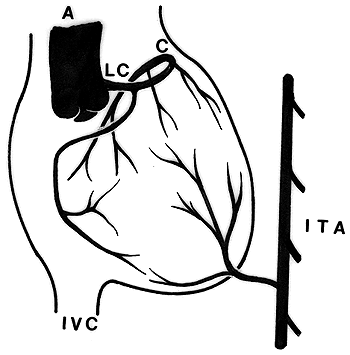 Image of variation of coronary system