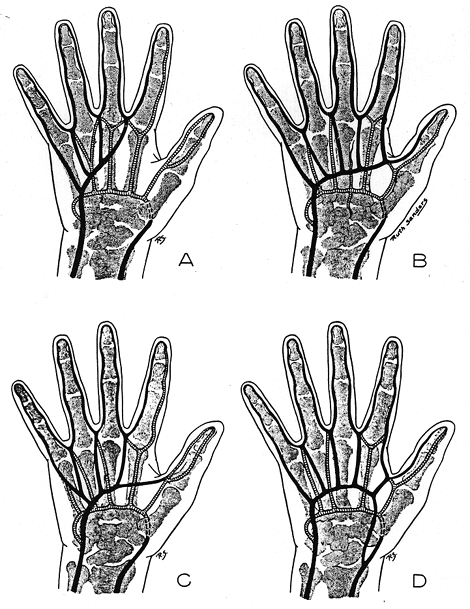 Image of some variations in superficial palmar arch