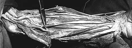 Image of Gantzer's muscle joining flexor pollicis longus