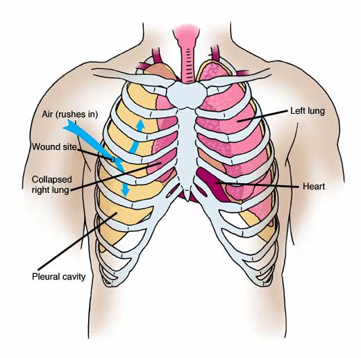 open pneumothorax dressing