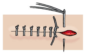 sutures clip art